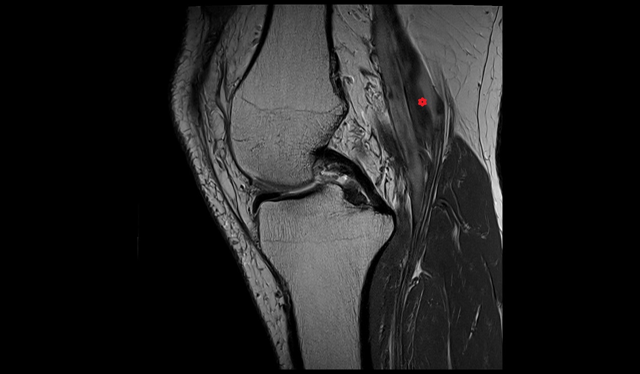 popliteal vein mri images
