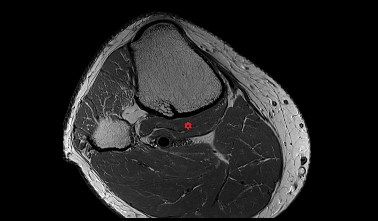 popliteus muscle anatomy