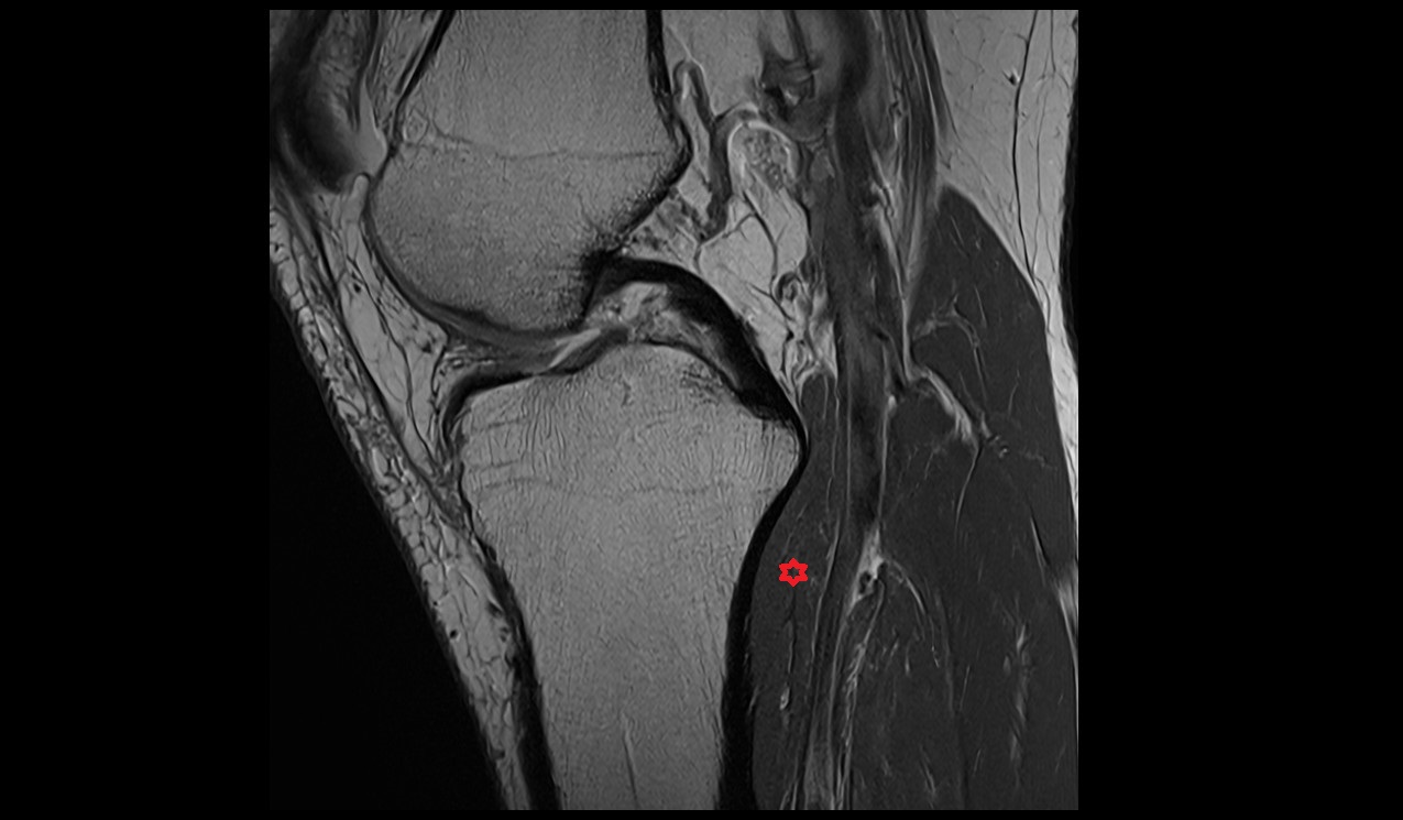 popliteus muscle anatomy mri image