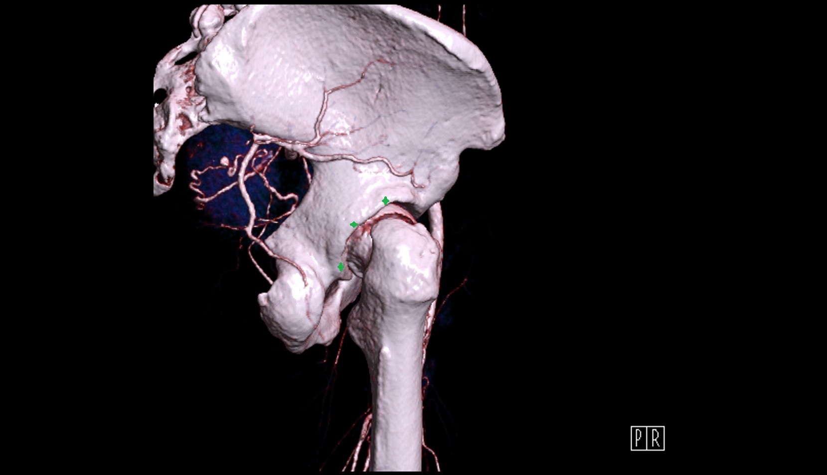 posterior acetabular wall 3d ct image