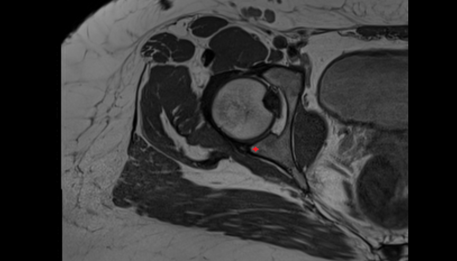 posterior acetabular wall  MRI  axial  anatomy  image-img-00000-00000