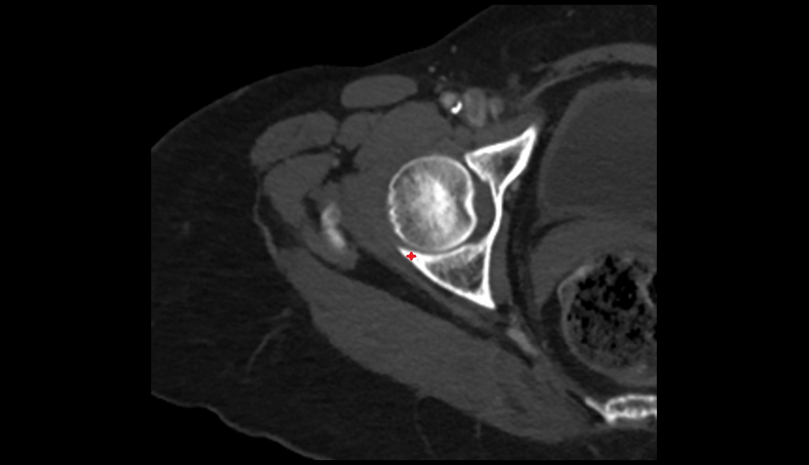 posterior acetabular wall ct axial image
