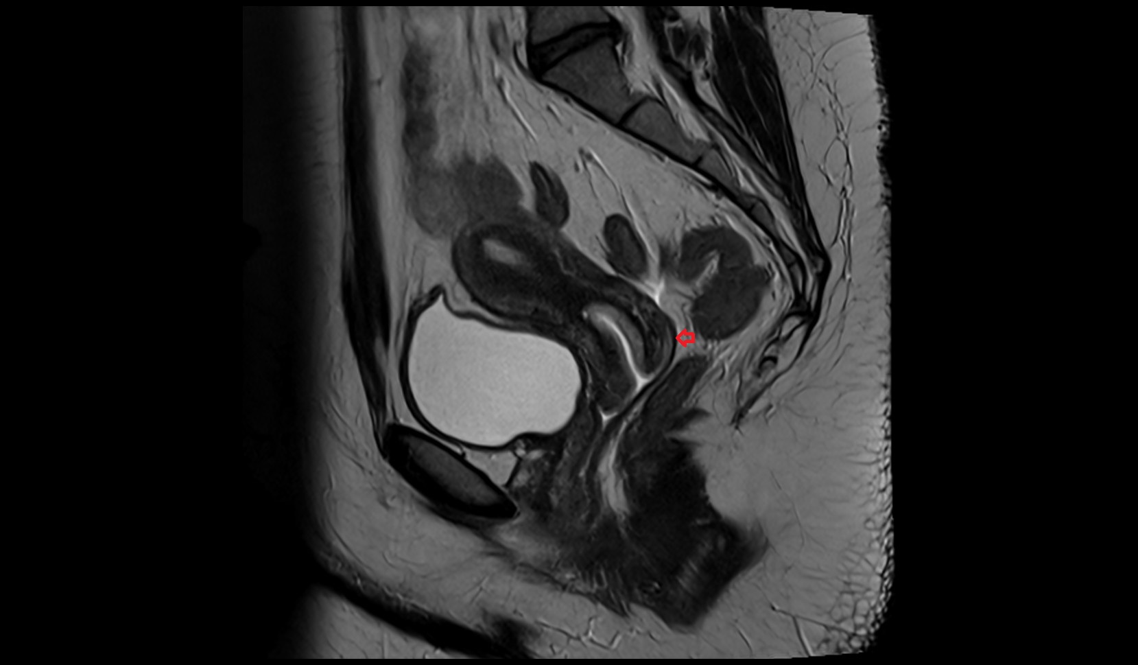 posterior fornix of cervix