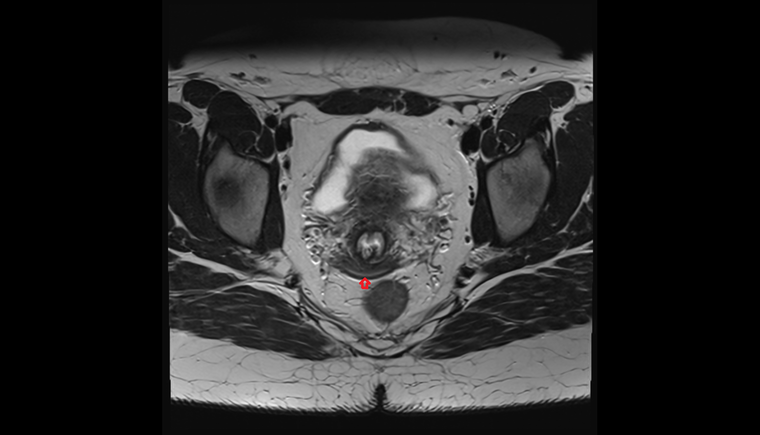 posterior fornix of cervix  MRI axial image-img-00000-00000