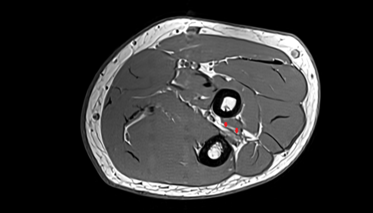 posterior interosseous artery axial cross sectional anatomy 3T MRI AI enhanced radiology image -img-00000-00000