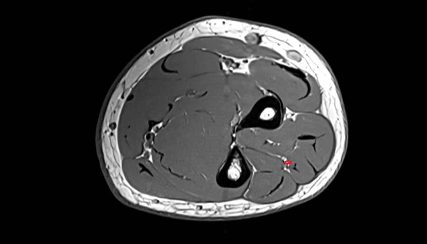 posterior interosseous artery axial cross sectional anatomy 3T MRI AI enhanced radiology image -img-00000-00000_00002