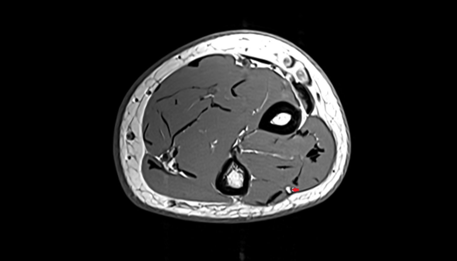 posterior interosseous artery axial cross sectional anatomy 3T MRI AI enhanced radiology image -img-00000-00000_00003