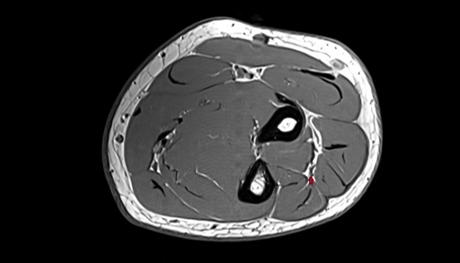 posterior interosseous veins  axial cross sectional anatomy 3T MRI AI enhanced radiology image -img-00000-00000_00001