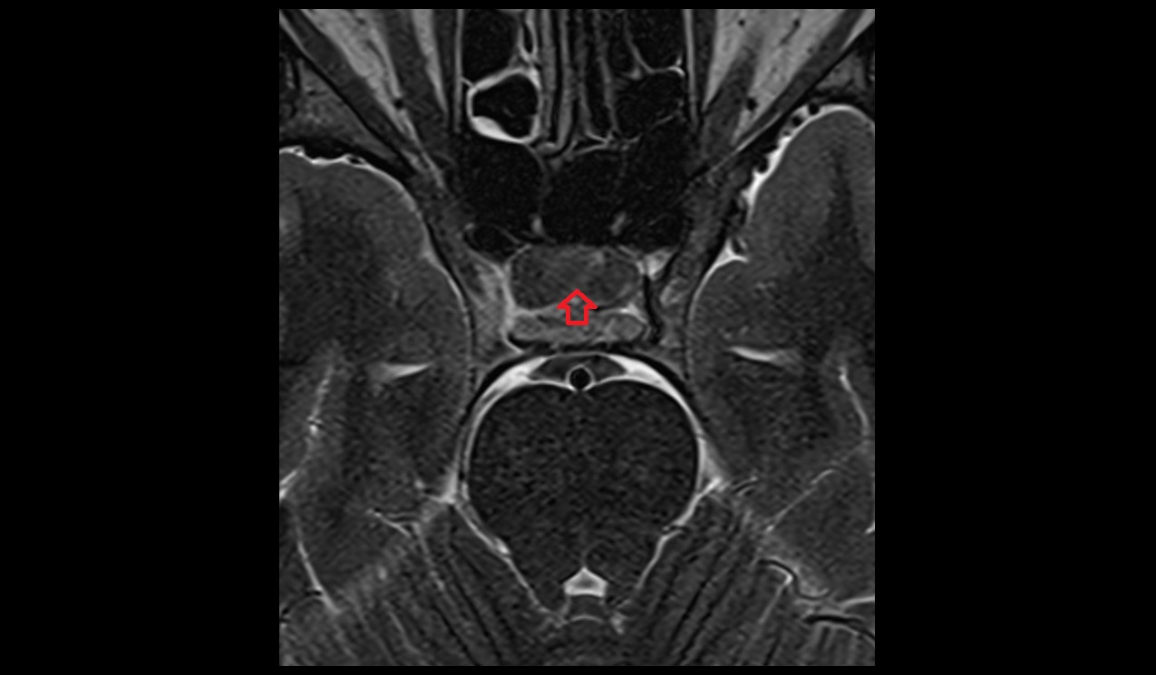 posterior lobe pituitary gland mri 3t axial image