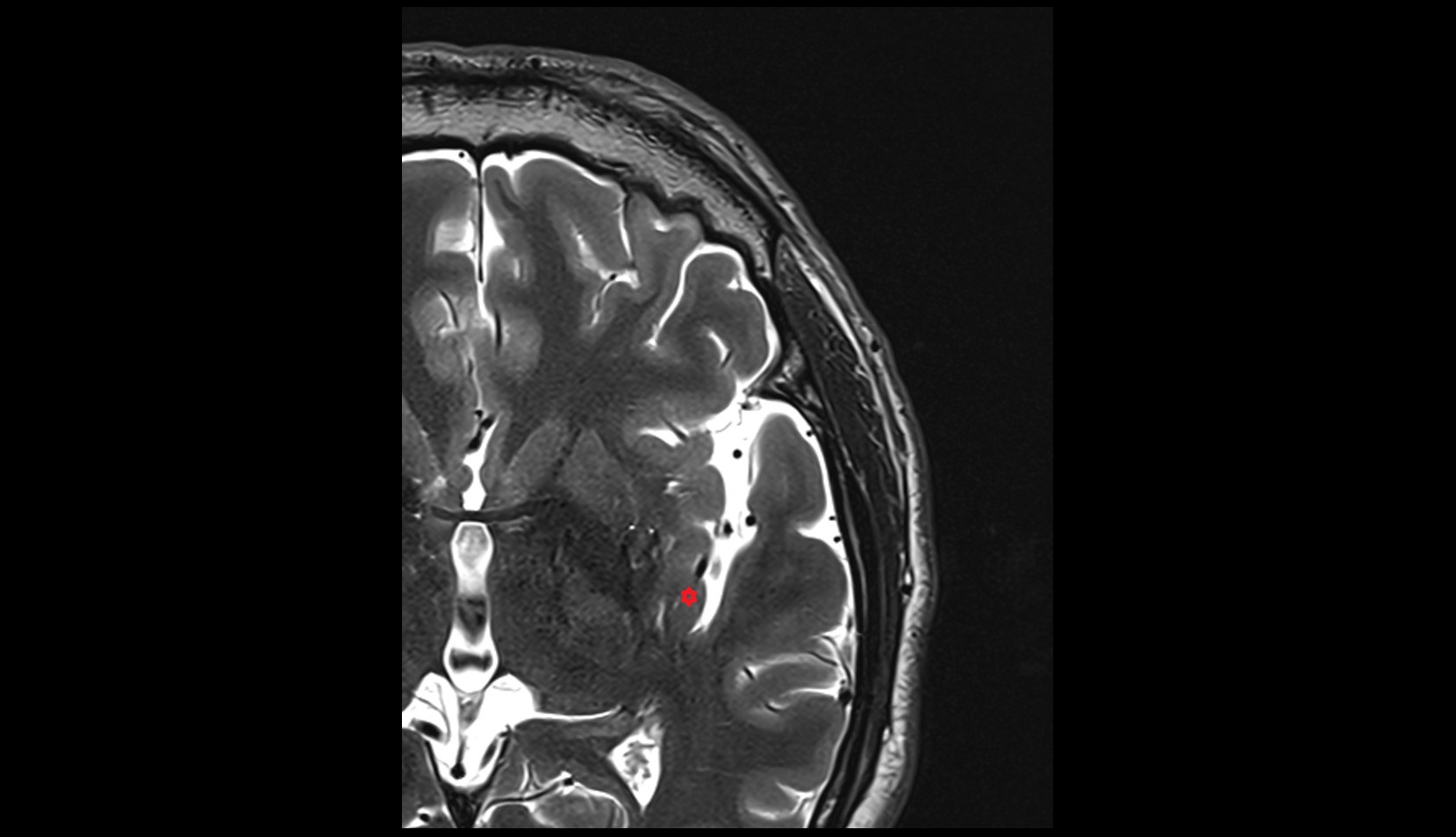 posterior long insular gyrus mri 3t axial image