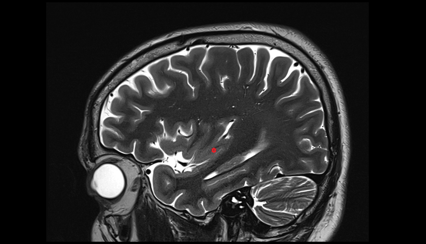 posterior long insular gyrus mri 3t sagittal image