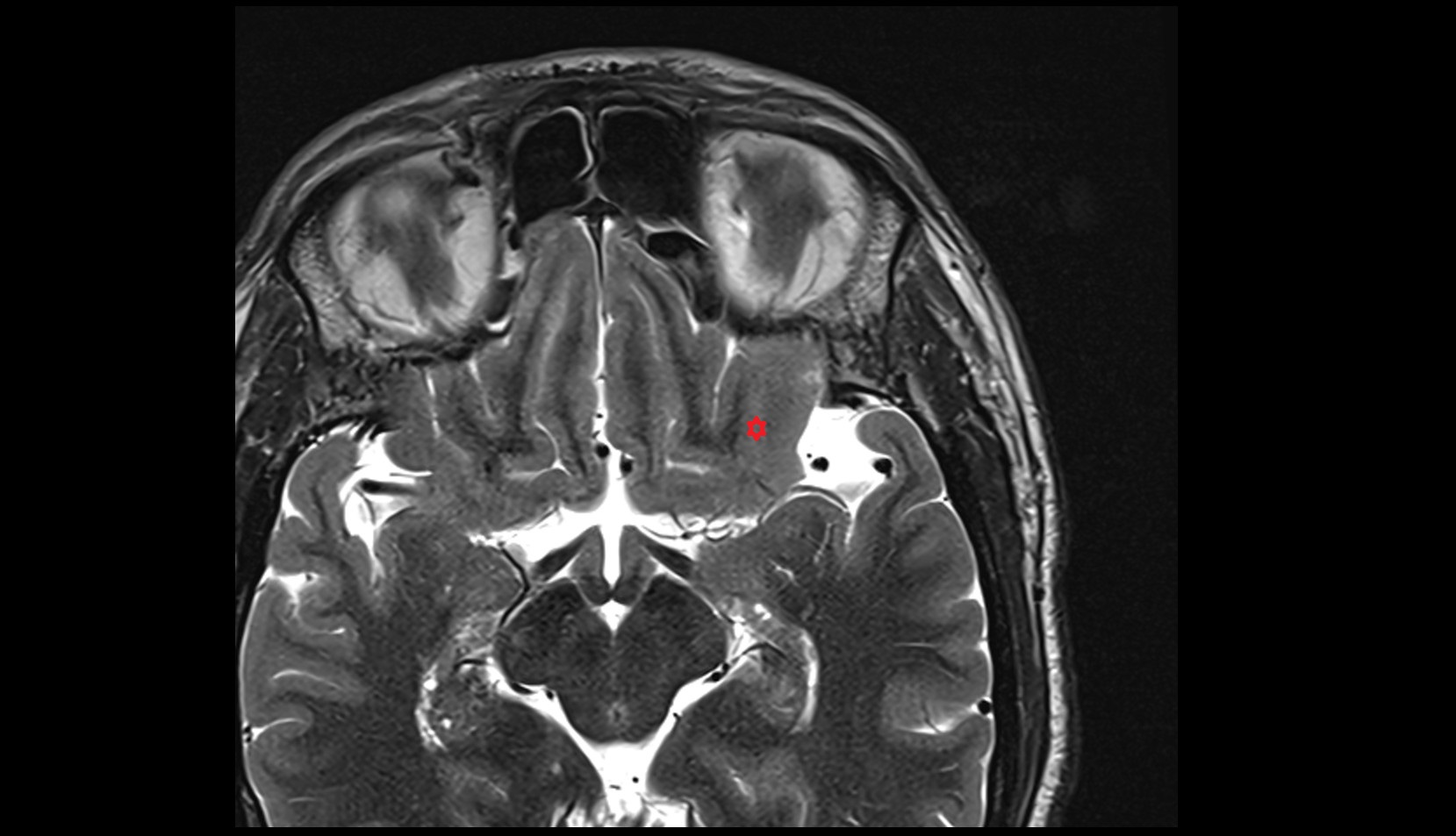 posterior orbital gyrus MRI 3T axial image