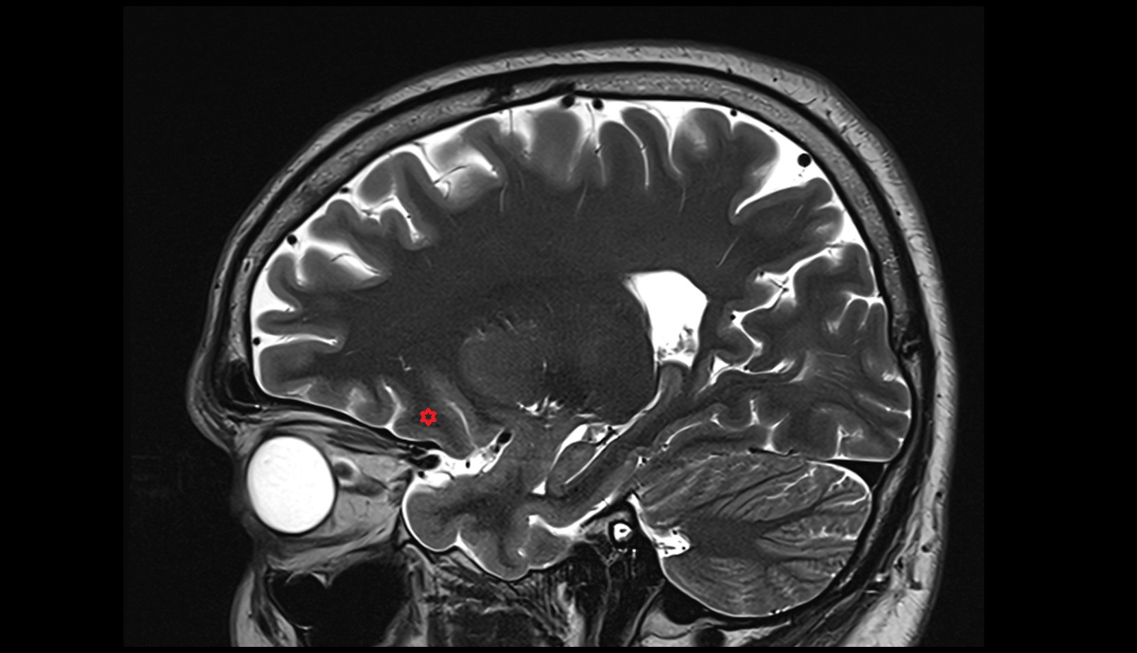 posterior orbital gyrus MRI 3T sagittal image
