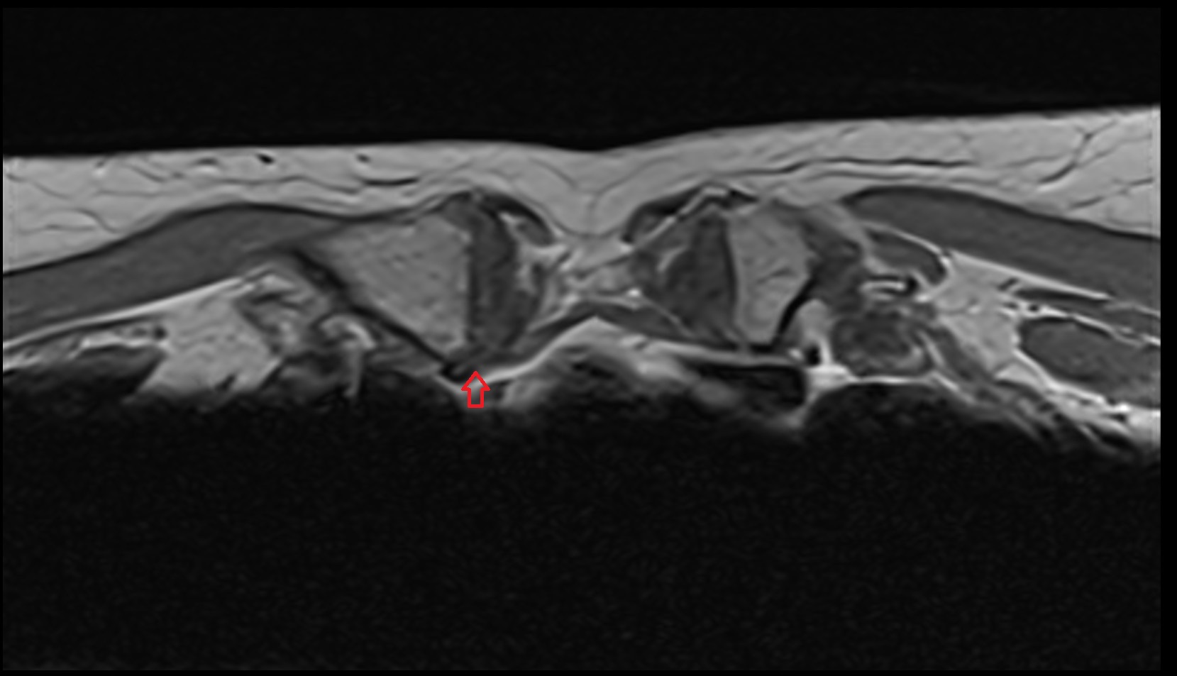 posterior sternoclavicular ligament axial mri image