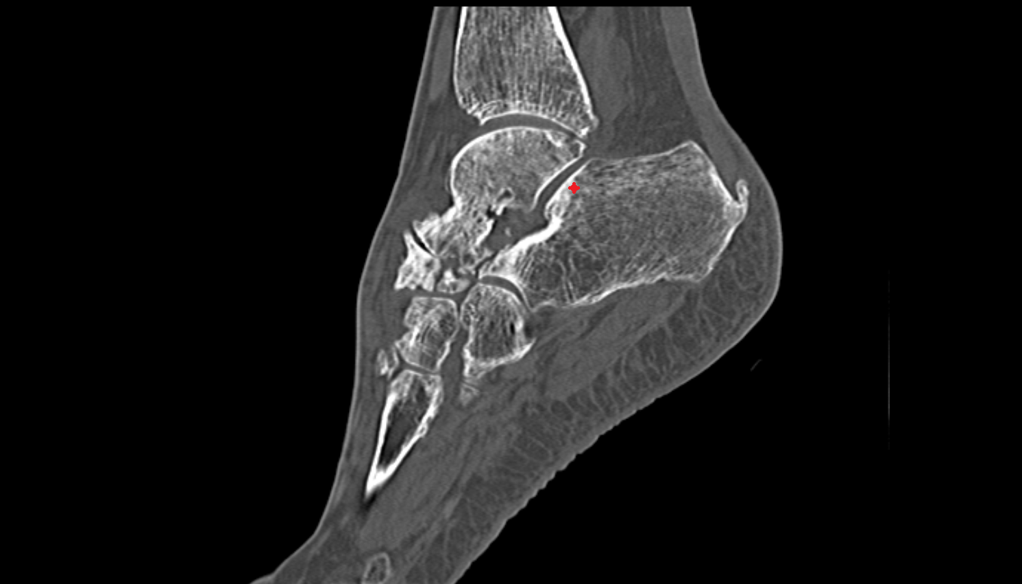 posterior talar articular surface   sagittal  CT cross sectional anatomy radiology image-img-00000-00000