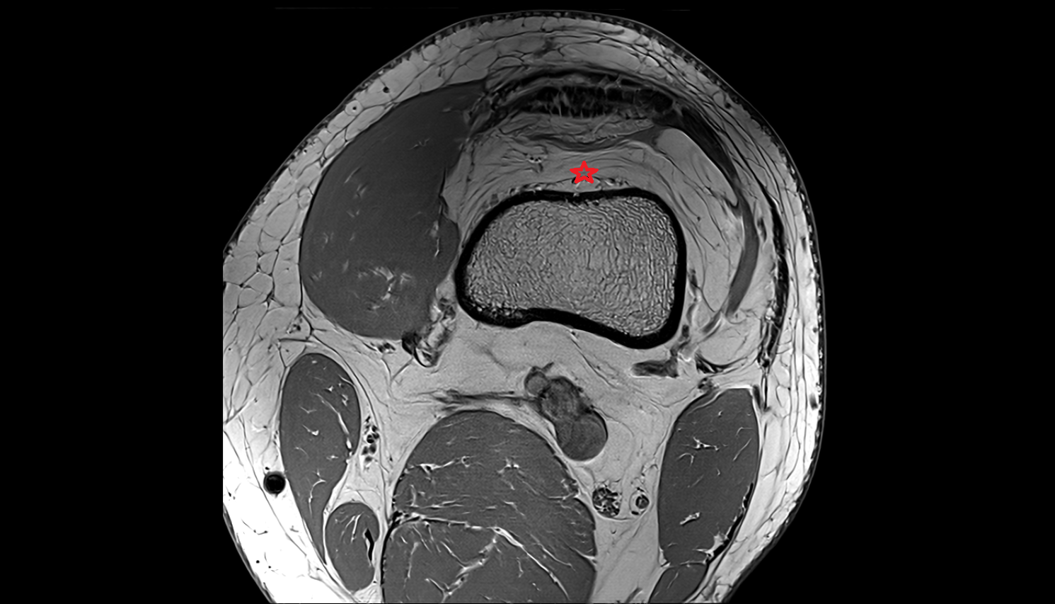 prefemoral fat pad axial  cross sectional anatomy 3T MRI AI enhanced  radiology  anatomy image1