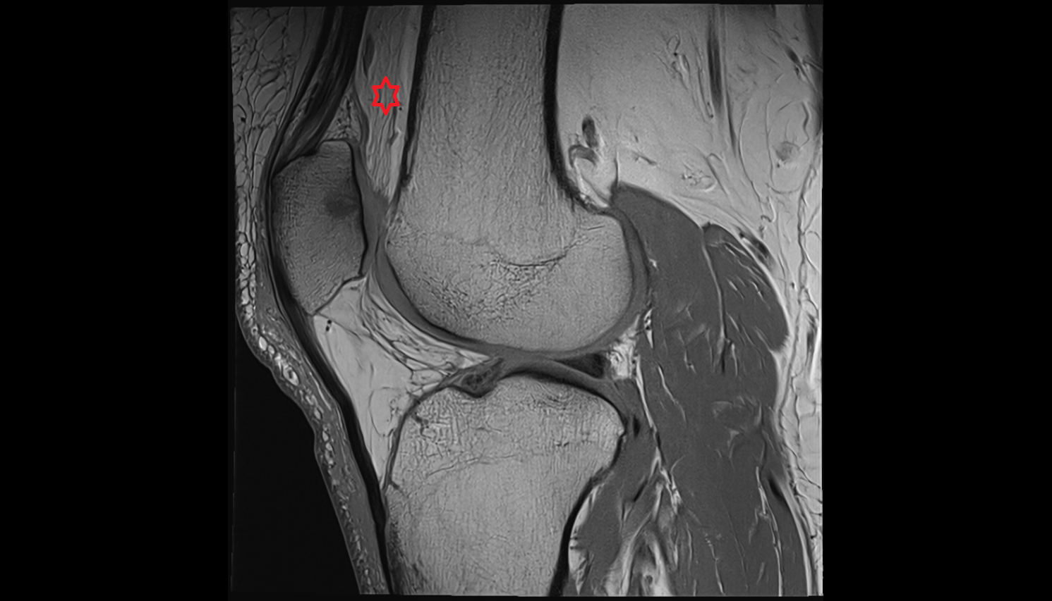 prefemoral fat pad sagittal  cross sectional anatomy 3T MRI AI enhanced  radiology  anatomy image-img-00000-00000