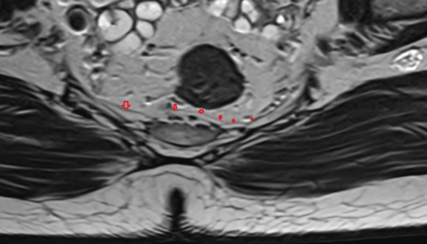 presacral fascia  MRI axial  anatomy  image-img-00000-00000