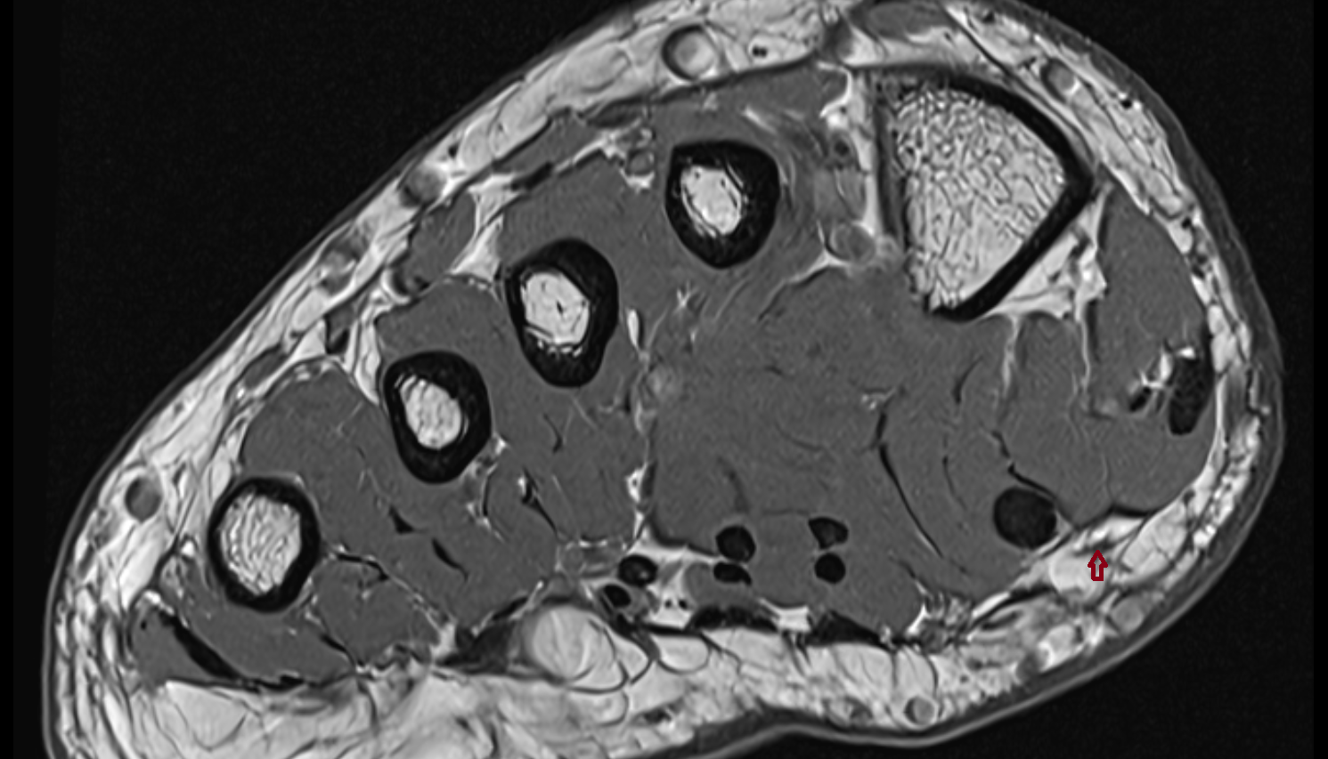 proper plantar digital nerve to great toe coronal cross sectional anatomy 3T MRI AI enhanced radiology image-img-00000-00000