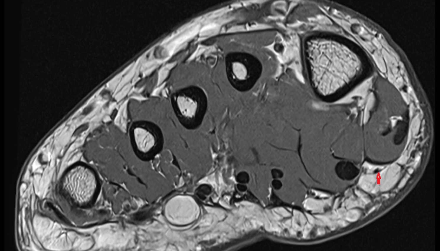 proper plantar digital nerve to great toe coronal cross sectional anatomy 3T MRI AI enhanced radiology image-img-00000-00000_00001