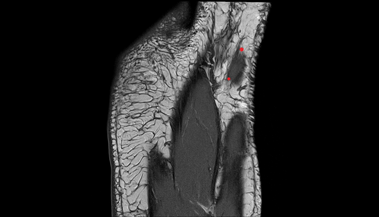 proper plantar digital nerve to great toe coronal cross sectional anatomy 3T MRI AI enhanced radiology image-img-00000-00000_00002