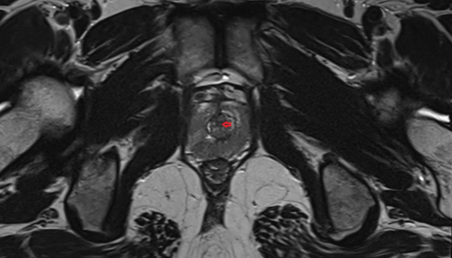 prostatic urethra  MRI  axial  anatomy  image-img-00000-00000