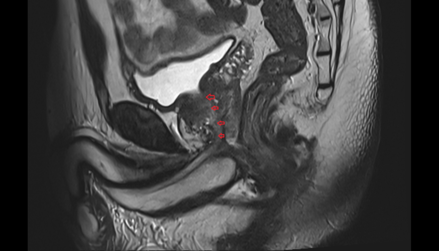 prostatic urethra  MRI  sagittal  anatomy  image-img-00000-00000