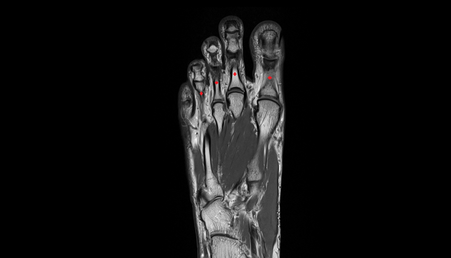 proximal phalanx foot coronal cross sectional anatomy 3T MRI AI enhanced radiology image-img-00000-00000