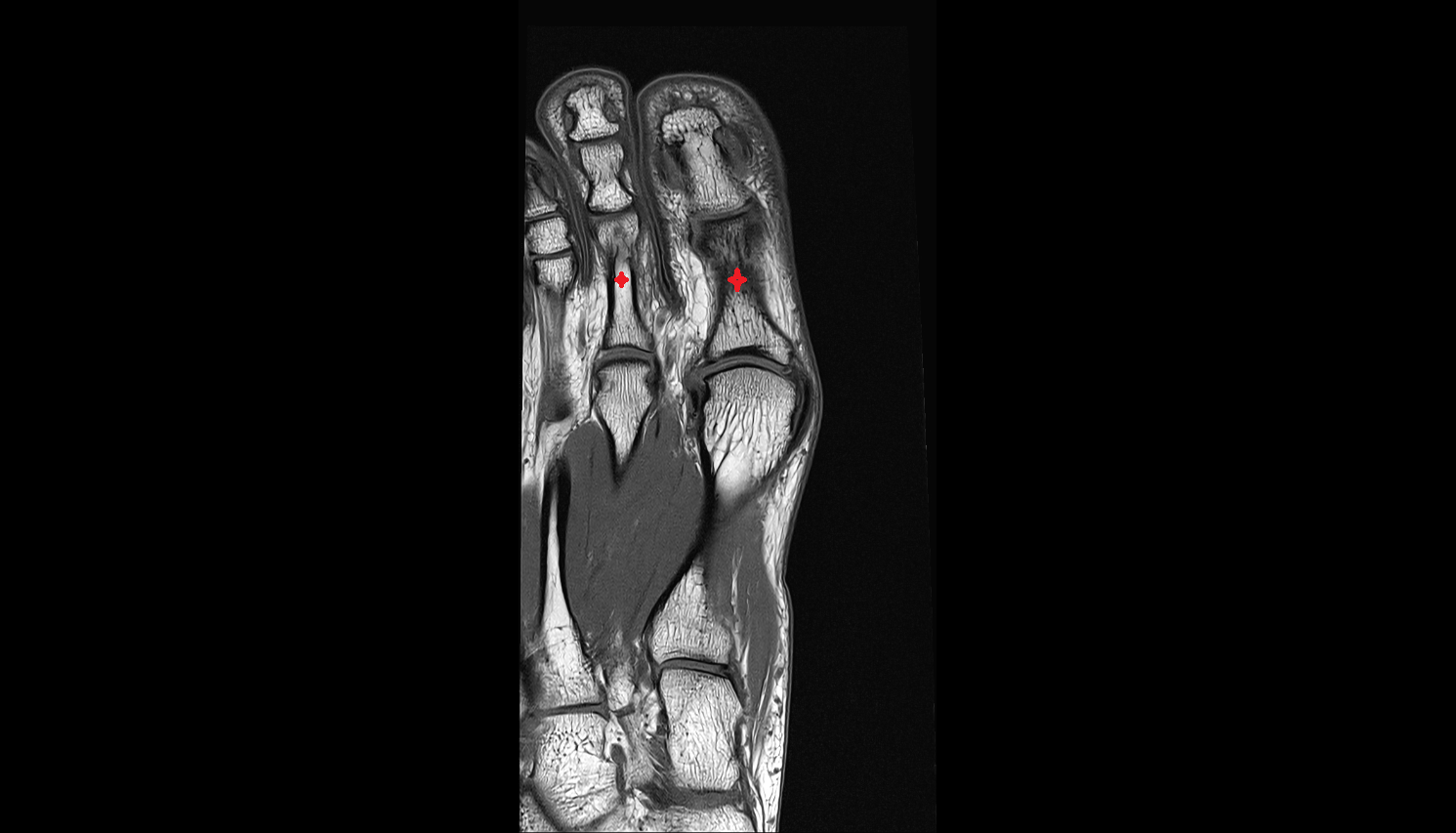 proximal phalanx foot coronal cross sectional anatomy 3T MRI AI enhanced radiology image-img-00000-00000_00001