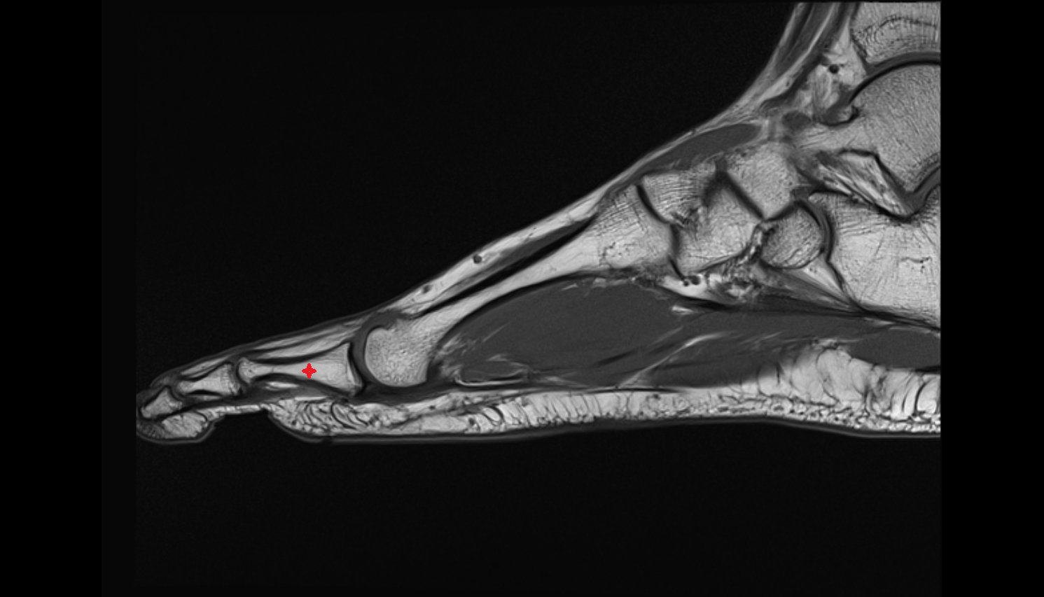 proximal phalanx foot sag cross sectional anatomy 3T MRI AI enhanced radiology image-img-00000-00000