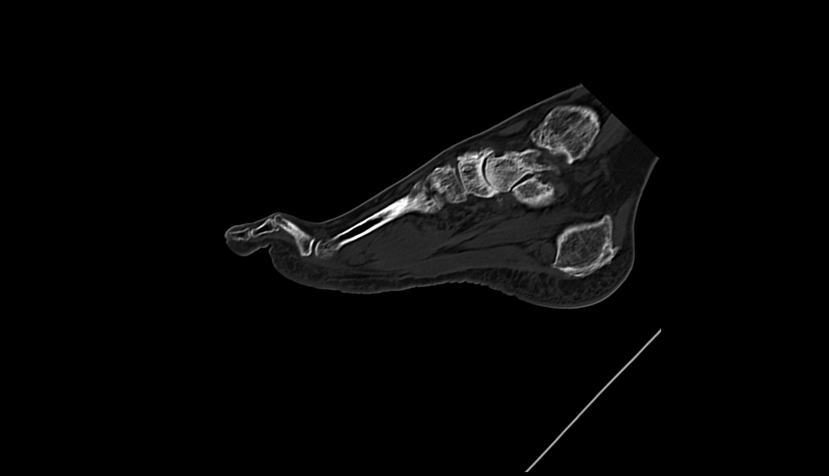 proximal phalanx of foot ct sag image