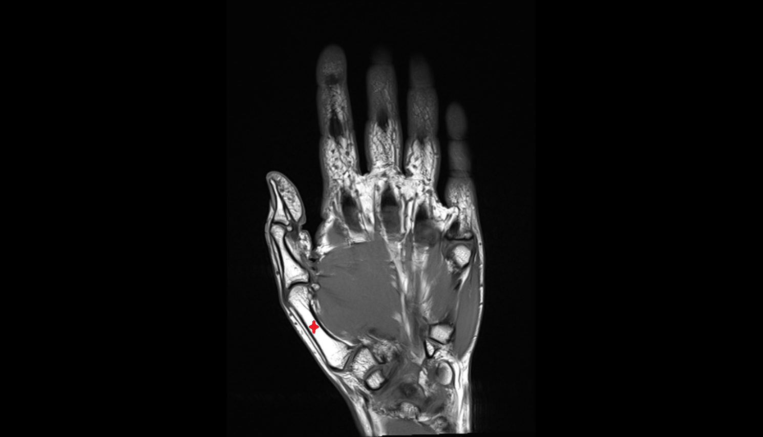 proximal phalanx of hand coronal cross sectional anatomy 3T MRI AI enhanced radiology image-img-00000-00000