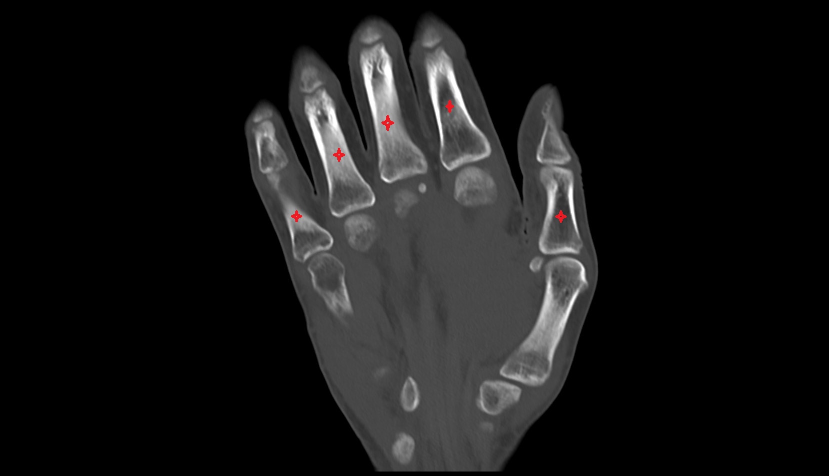 proximal phalanx of hand coronal ct image