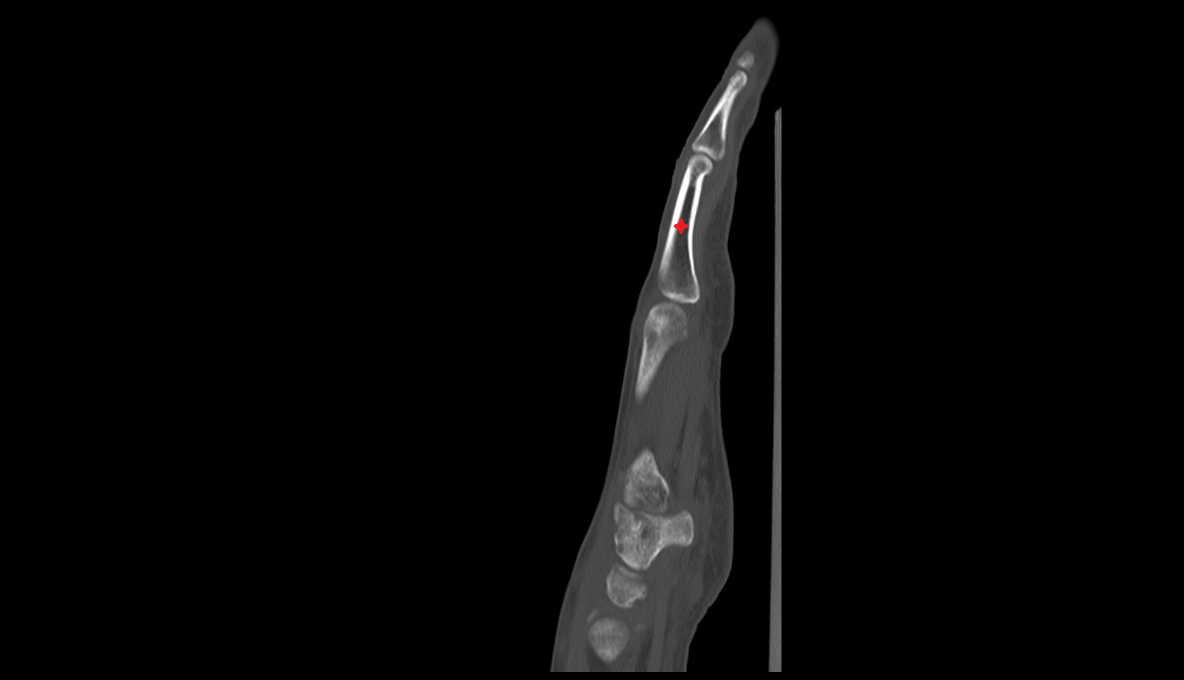 proximal phalanx of hand ct sag image