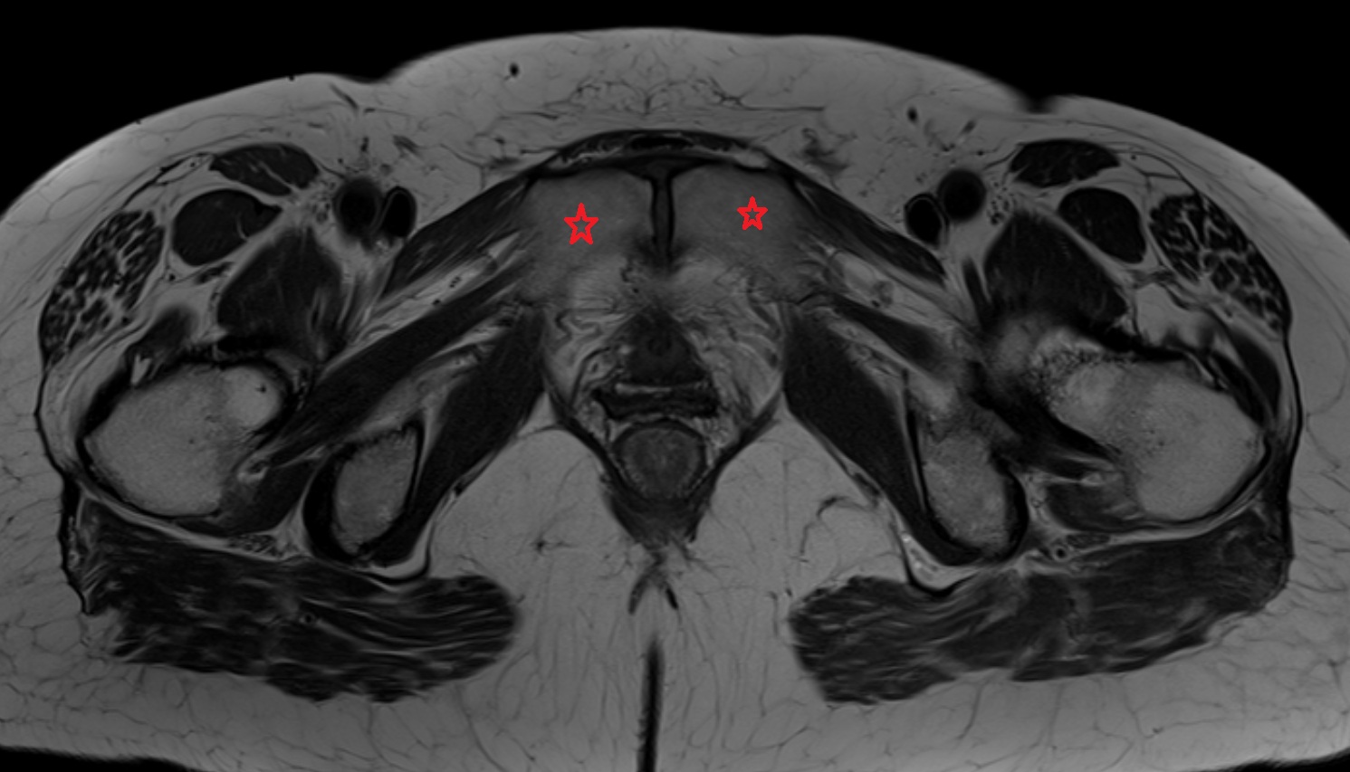 pubic bone  MRI  axial  anatomy  image-img-00000-00000