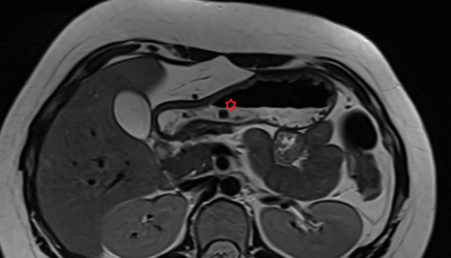 pyloric antrum  anatomy  MRI axial  image -img-00000-00000