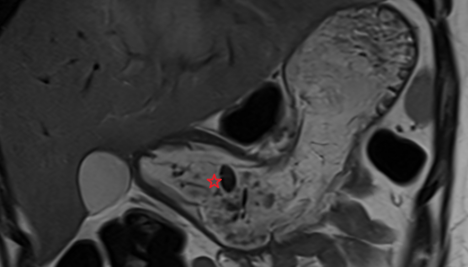 pyloric antrum  anatomy  MRIcoronal  image -img-00000-00000