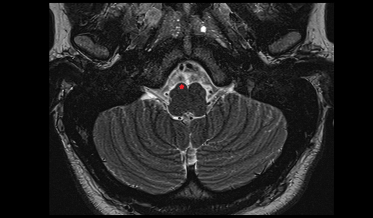 pyramids of the medulla oblongata mri 3t axial image