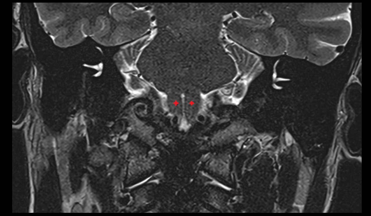 pyramids of the medulla oblongata mri 3t  coronal image