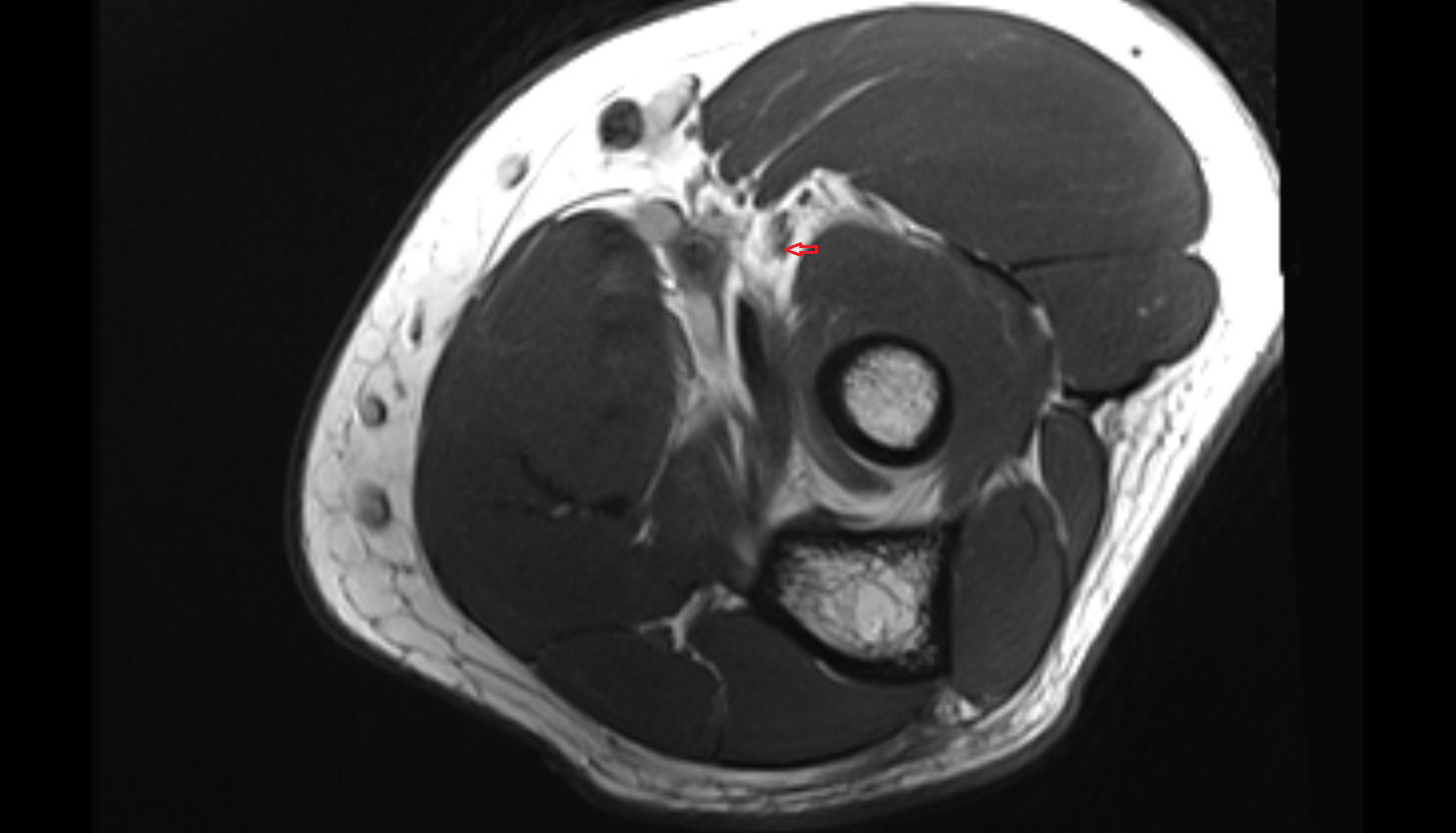 radial recurrent artery axial cross sectional anatomy 3T MRI AI enhanced radiology image -img-00000-00000