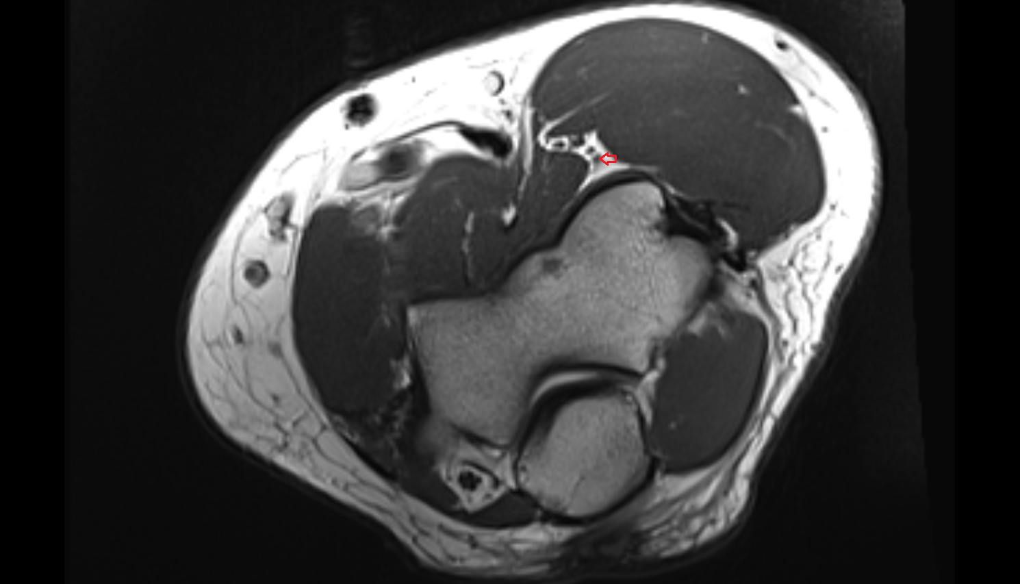 radial recurrent artery axial cross sectional anatomy 3T MRI AI enhanced radiology image -img-00000-00000_00001
