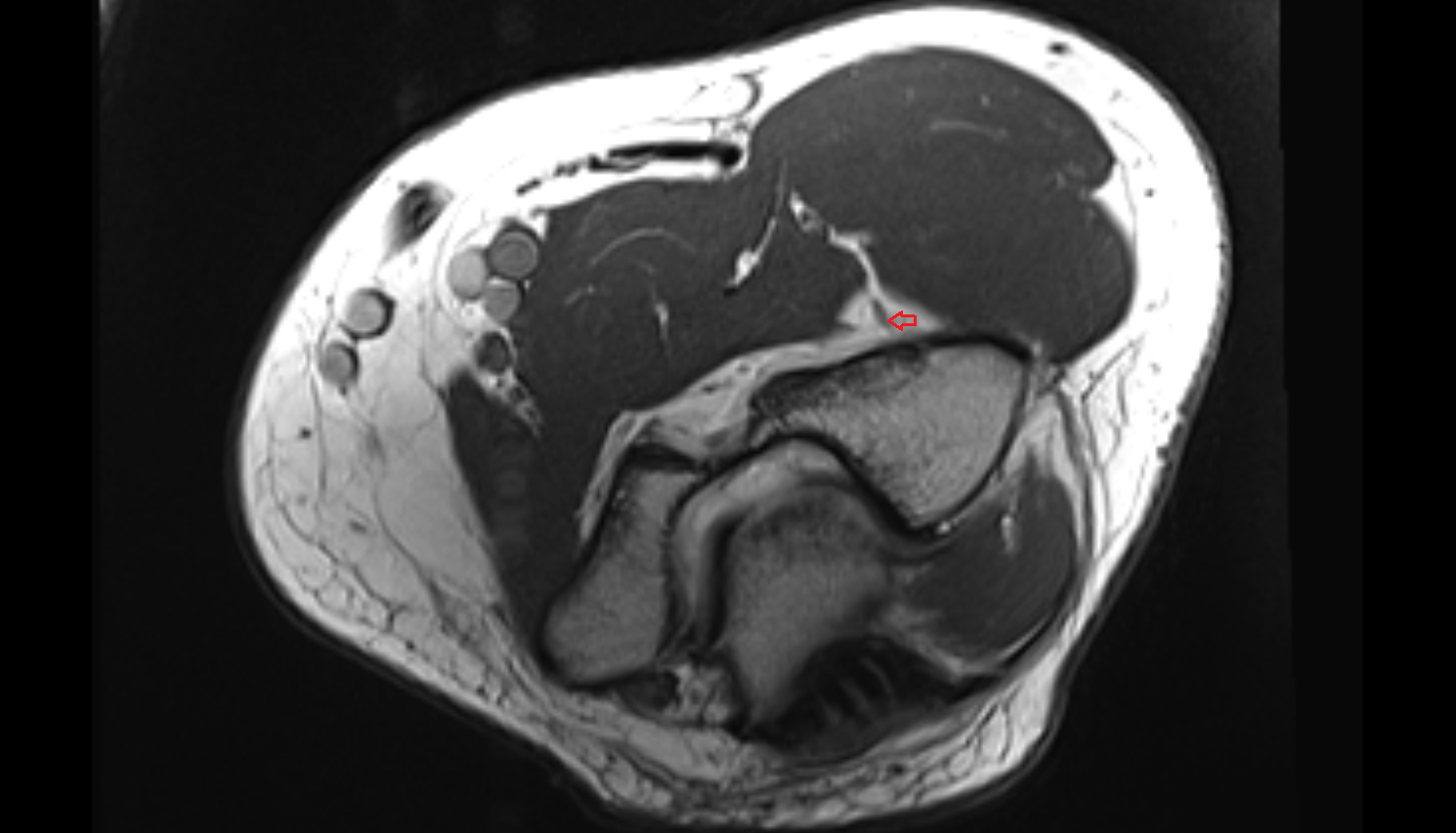 radial recurrent artery axial cross sectional anatomy 3T MRI AI enhanced radiology image -img-00000-00000_00002