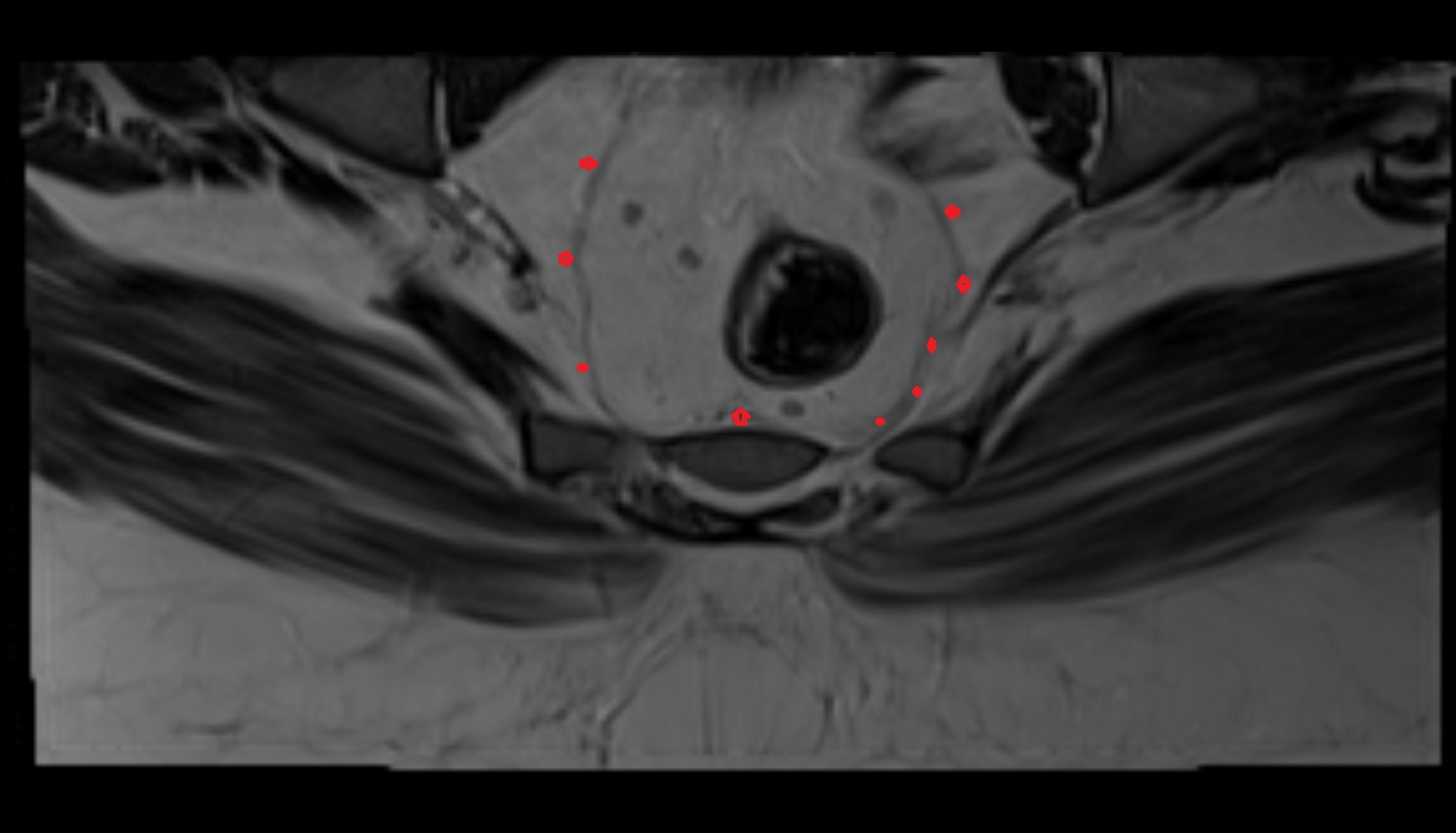 rectal proper fascia ( fascia propria of the rectum )  MRI axial  anatomy  image-img-00000-00000