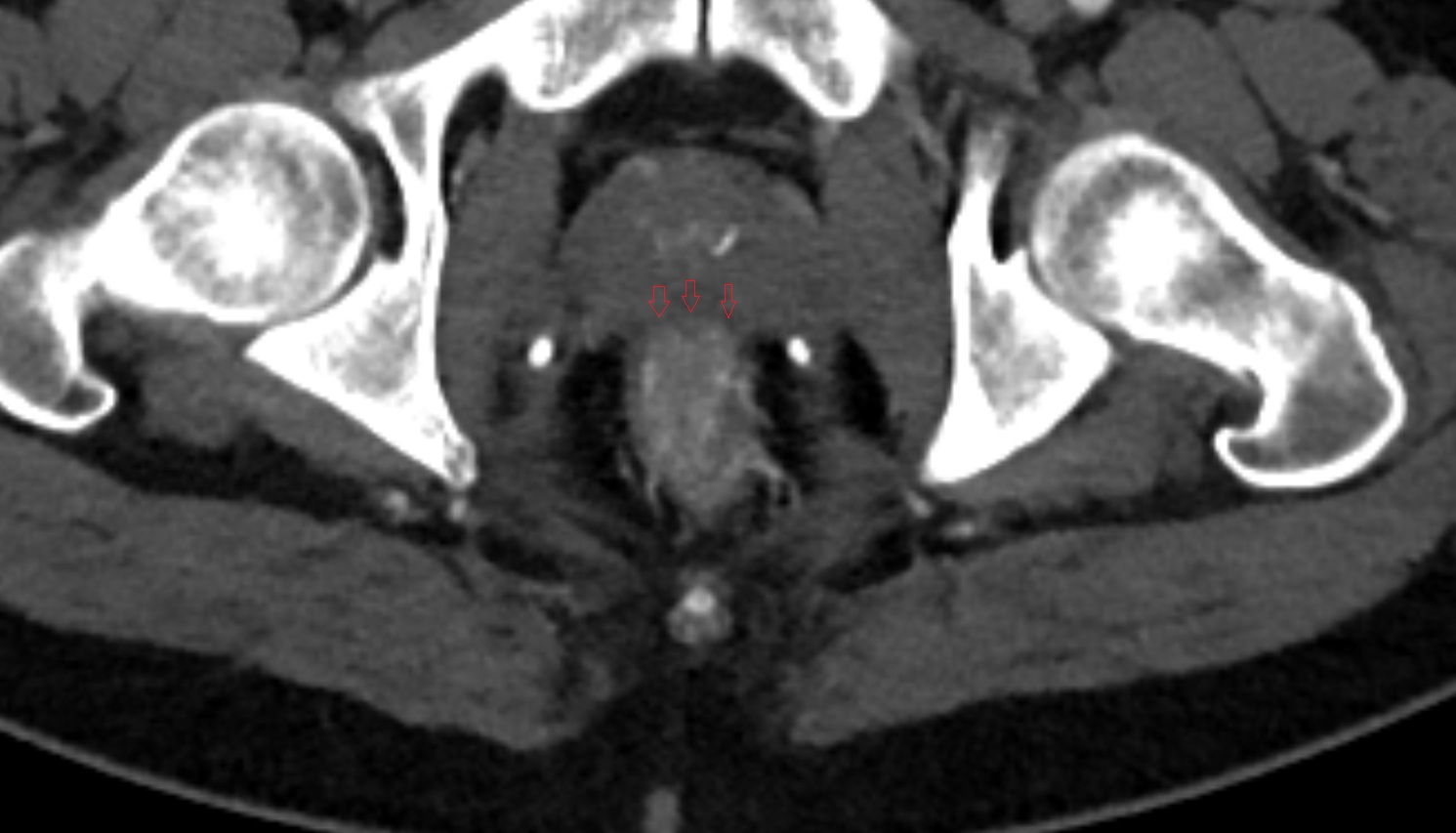 rectoprostatic fascia (Denonvilliers' fascia)  CT  AXIAL   anatomy  image-img-00000-00000