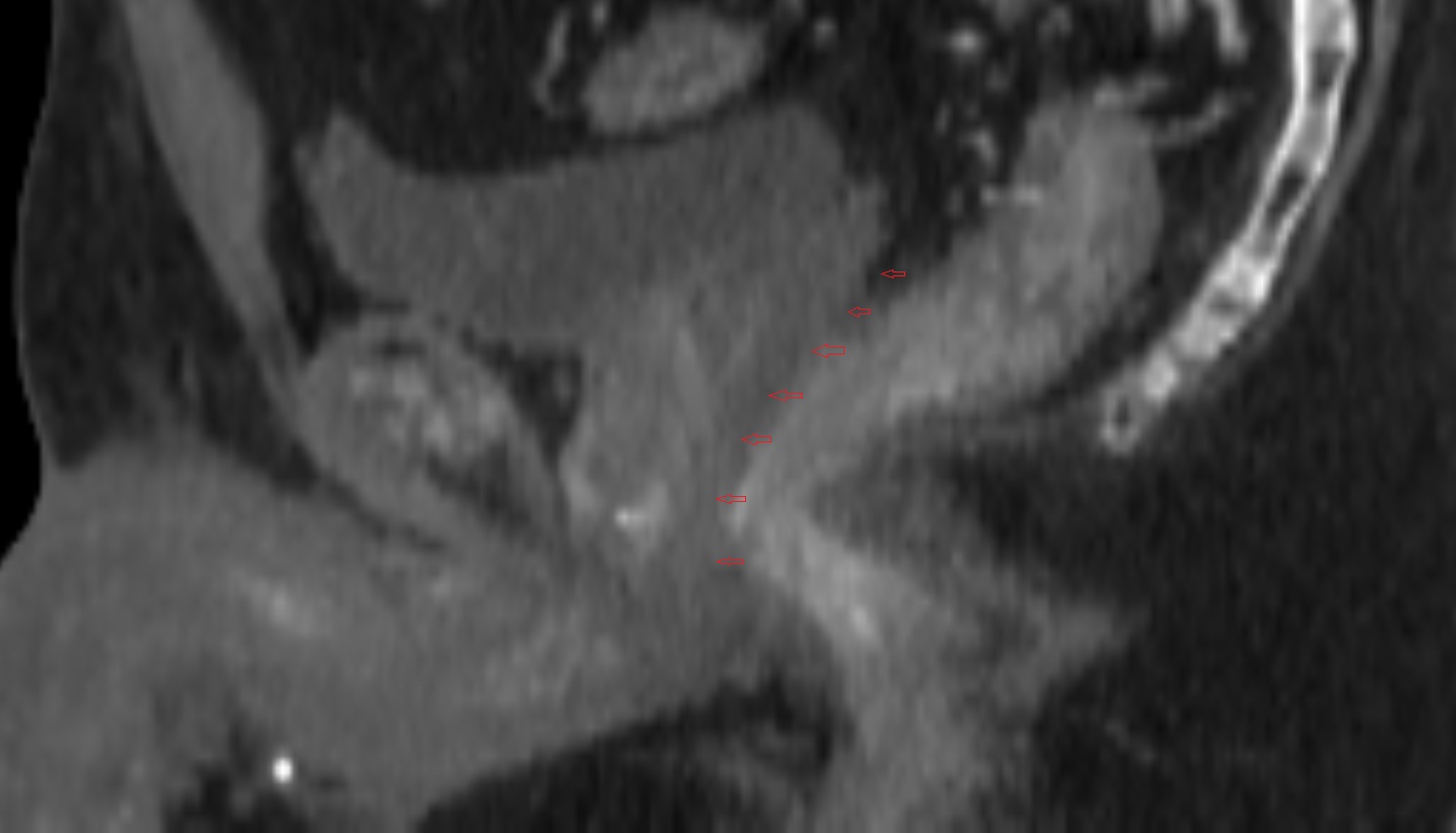 rectoprostatic fascia (Denonvilliers' fascia)  CT  SAGITTAL   anatomy  image-img-00000-00000