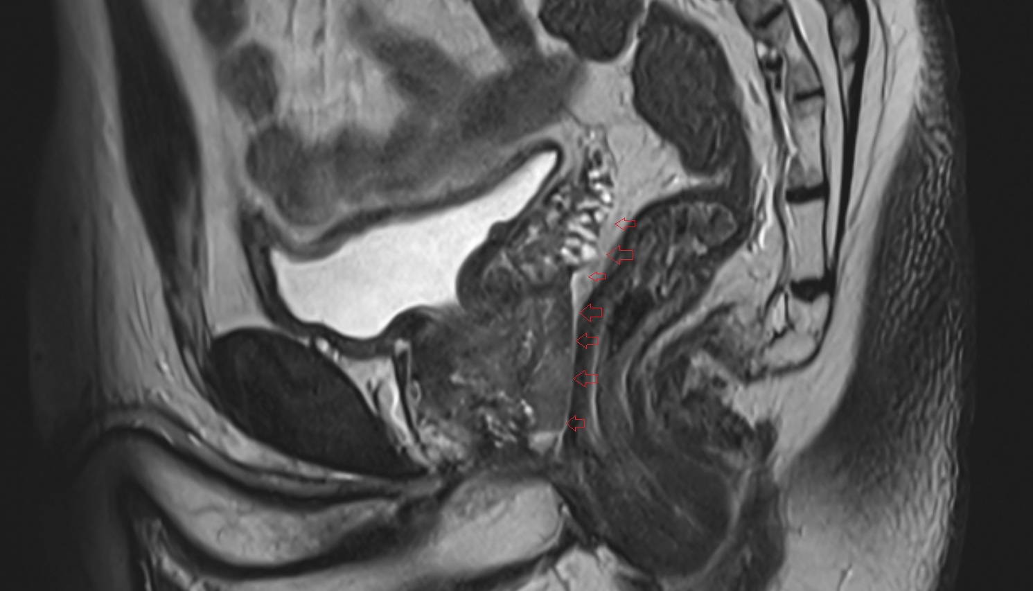 rectoprostatic fascia (Denonvilliers' fascia)  MRI  SAGITTAL   anatomy  image-img-00000-00000
