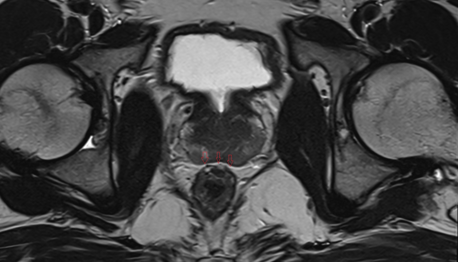rectoprostatic fascia (Denonvilliers' fascia)  MRI  axial  anatomy  image-img-00000-00000