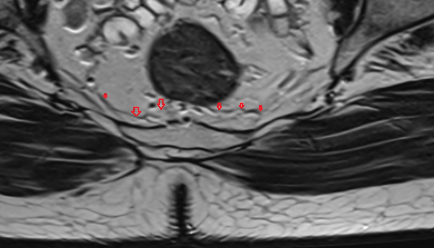rectosacral fascia (Waldeyer’s fascia  MRI axial  anatomy  image-img-00000-00000