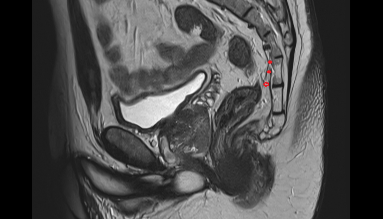 rectosacral fascia (Waldeyer’s fascia  MRI sagittal   anatomy  image-img-00000-00000
