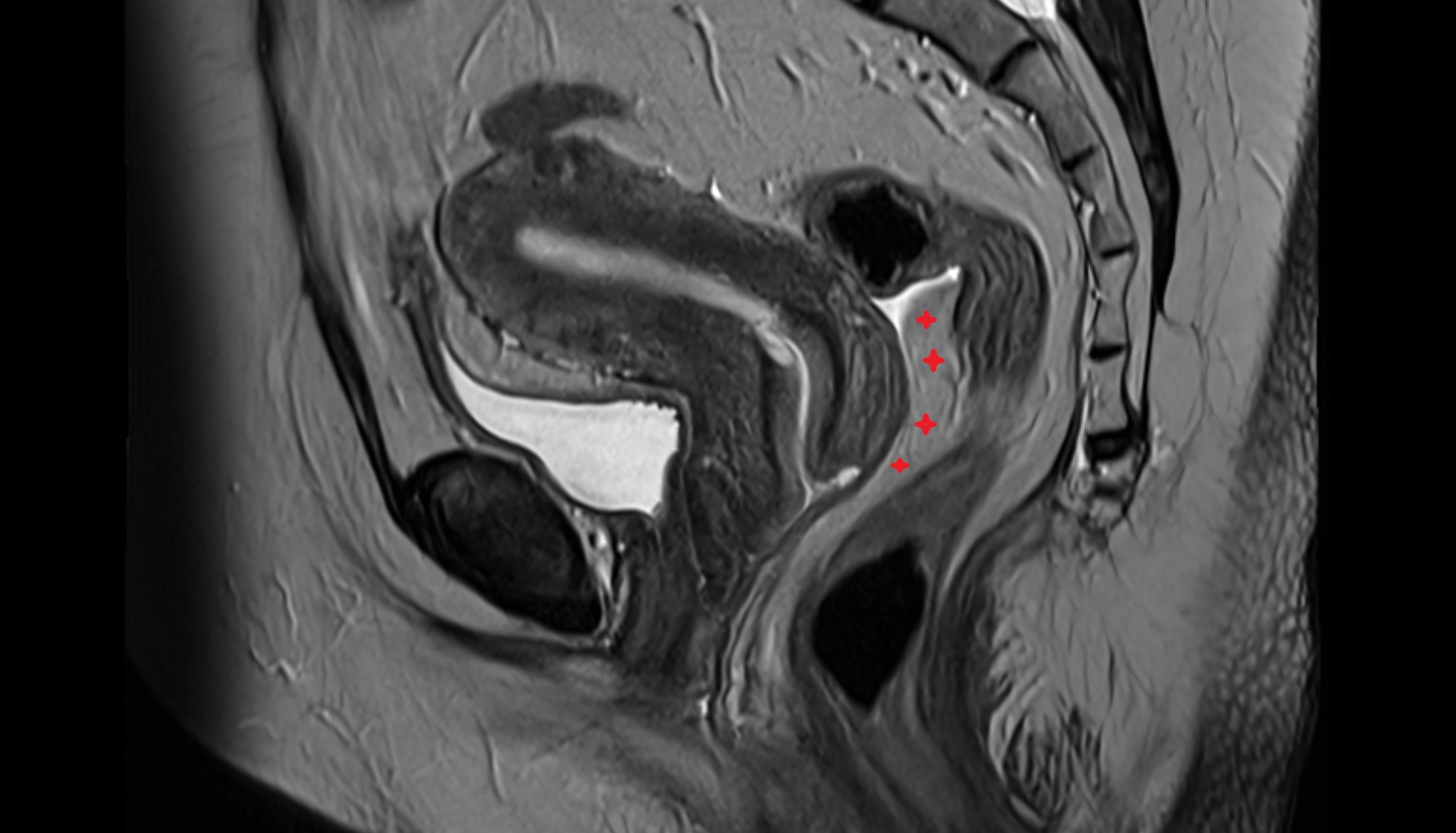 rectouterine pouch  MRI sagittal  anatomy  image-img-00000-00000